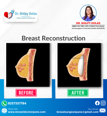 If you need breast cancer surgery in Pune, trust Dr. Shilpy Dolas, who specializes in advanced surgical options with compassionate care for each patient.