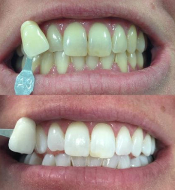 Get the Perfect White Smile: Crest Teeth Whitening Step-by-Step
